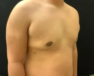 Gynecomastia