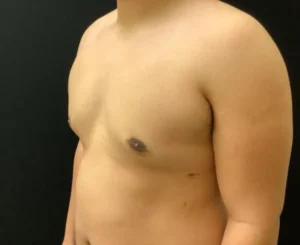 Gynecomastia