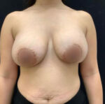 Breast Augmentation