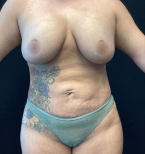 Liposuction