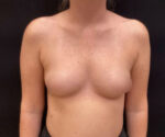 Breast Augmentation
