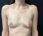 Breast Augmentation