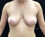 Breast Augmentation