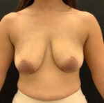 Breast Augmentation