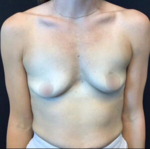Breast Augmentation