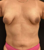 Breast Augmentation