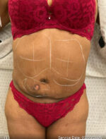 Liposuction