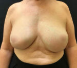 Breast Augmentation
