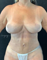 Breast Implant Removal