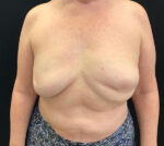 Breast Augmentation