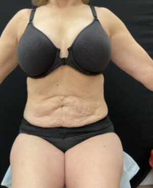 BodyTite