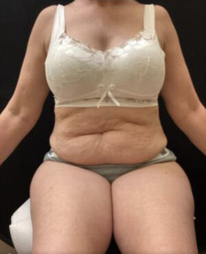 BodyTite