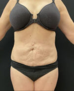 BodyTite