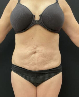 BodyTite