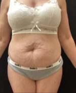BodyTite