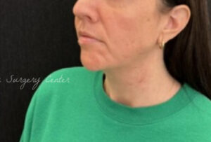 Facetite