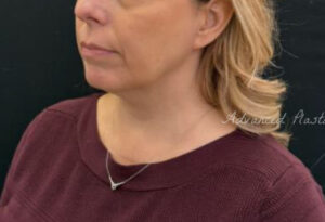 Facetite