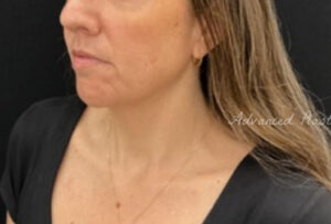 Facetite