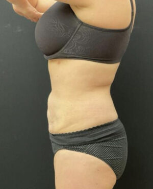 BodyTite