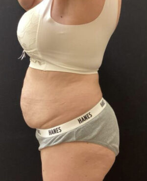 BodyTite