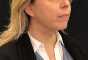 Facetite