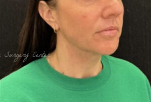 Facetite