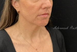Facetite