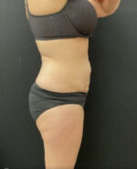 BodyTite