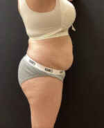 BodyTite