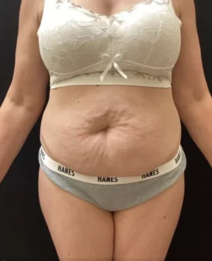 BodyTite