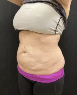 BodyTite