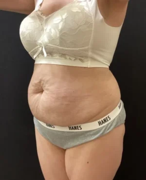 BodyTite