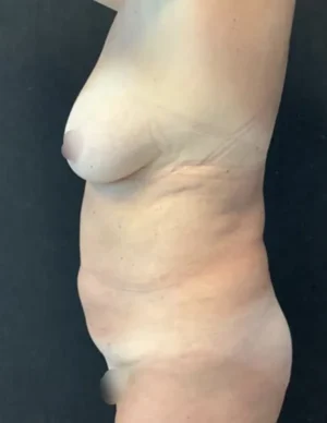 BodyTite