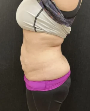 BodyTite