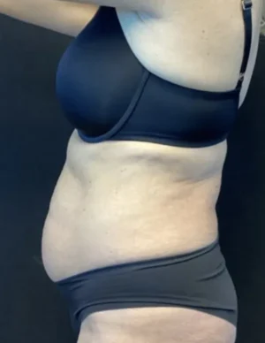 BodyTite