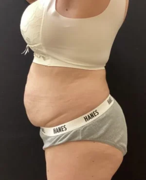 BodyTite