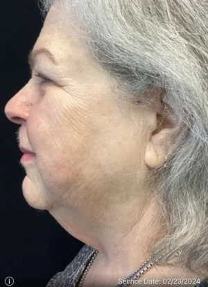 Neck Lift