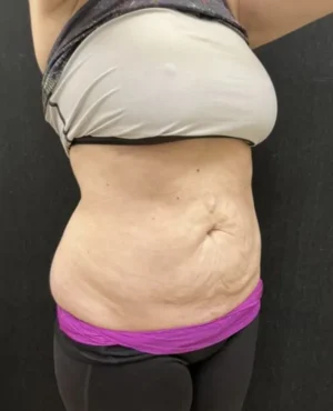 BodyTite