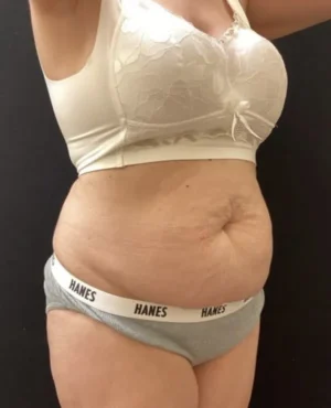 BodyTite