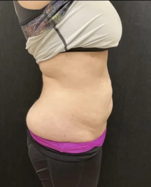 BodyTite