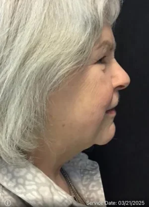 Neck Lift