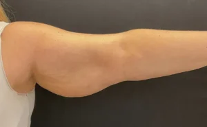 BodyTite