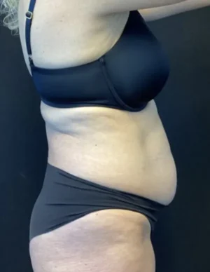 BodyTite