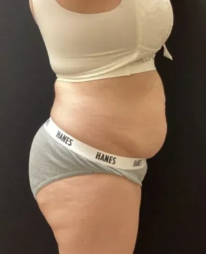 BodyTite