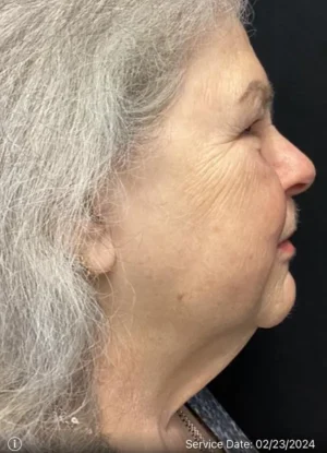 Neck Lift
