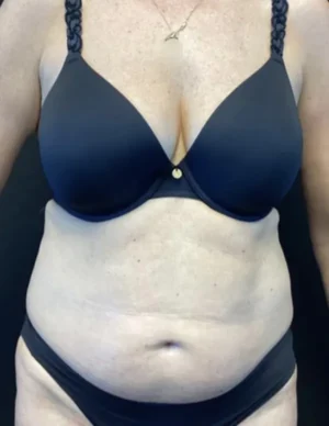 BodyTite