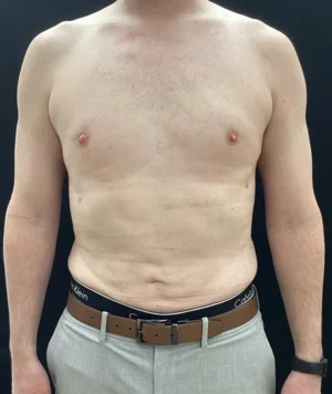 Liposuction for Men