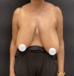 Breast Reduction
