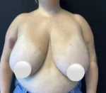 Breast Reduction
