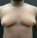 Gynecomastia